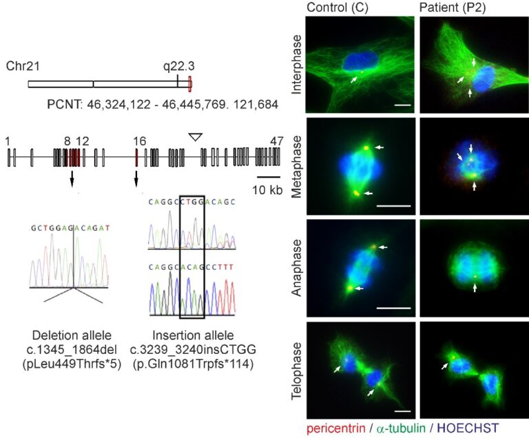 Fig. 6: Abnormal mitotic morphology of MOPDII patient fibroblasts with mutated PCNT variants