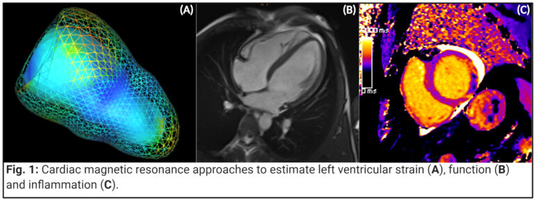Fig. 1: Cardiac magnetic resonance approaches to estimate left ventricular strain (A), function (B) and inflammation (C). Copyright: Univ.-Prof. Dr. Bernhard Metzler, MSc