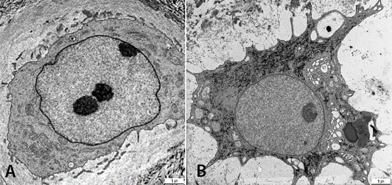 Fig. 3: Intervertebral disc cell of a 4 month old SPARC Null KO mouse (A) and a human cell of a prolapsed disc (B): Both Balloon cells at a magnification of 4000x, presenting mostly euchromatin and a nucleulus in the nucleus which is enveloped by an osmiophilic nucleus membrane (Copyright: PD Dr. Ingrid Sitte - MUI )