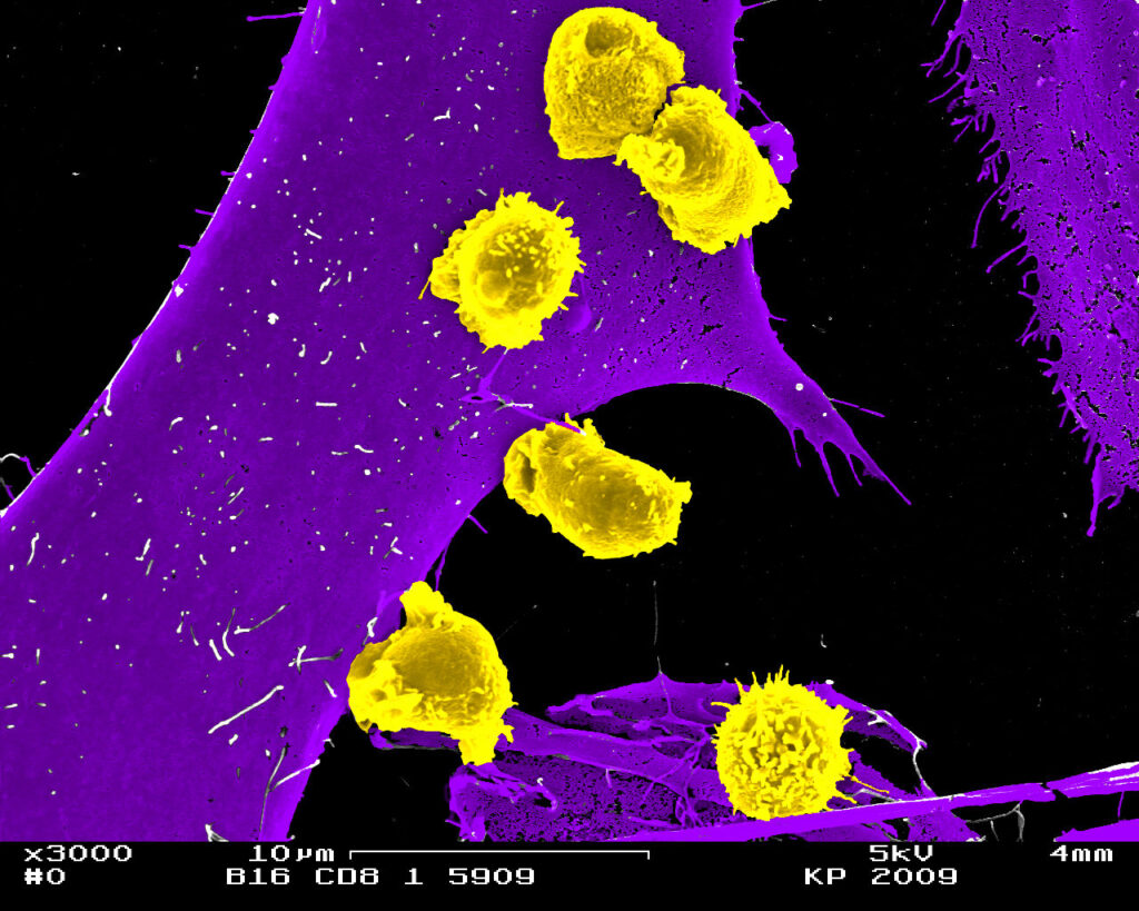 Fig. 2: Image of cytotoxic CD8+ T lymphocytes (in yellow) attacking a tumor cell (in purple) (Copyright: MUI/Kristian Pfaller)