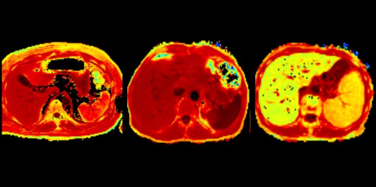 Fig. 3: MRI R2* maps in a patient with anaemia of inflammation (left), a control individual without inflammation (middle), and a patient with transfusion-related iron overload (right)–dark red means low R2* values and thus low iron concentrations; bright red and orange mean higher R2* values and thus higher iron concentrations; while yellow/green depict the highest iron concentrations. From Lanser et al. Am J Hematol 2023 (https://doi.org/10.1002/ajh.26909)