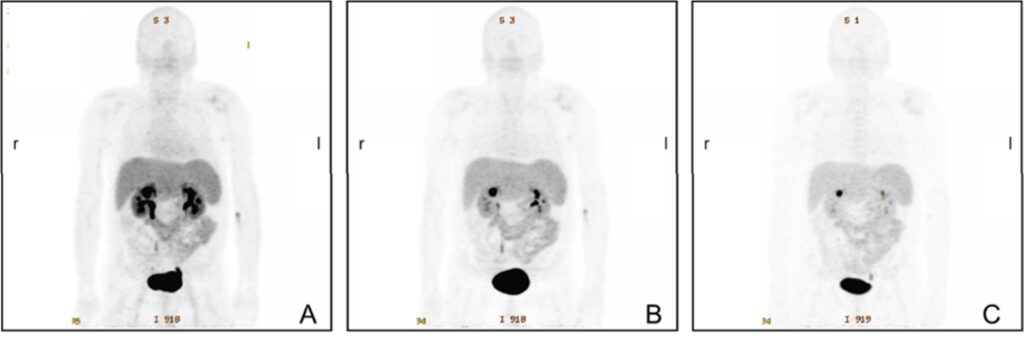 Fig 4: Maximum-intensity projections from static [68Ga] NODAGA-RGD PET scans of a male patient with hepatocellular carcinoma at 13 min (A), 40 min (B), and 76 min (C) after tracer injection. The tracer shows rapid predominant renal elimination with the highest activity in the bladder, kidneys, liver, spleen and intestine. Low background activity is found in the brain, thorax and extremities, resulting in a low radiation dose for the patient. For all three images, the grey-scale is set to the same value. Image from [8]