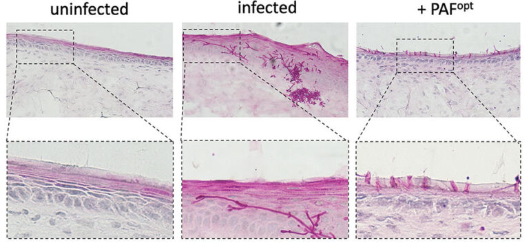 Fig. 3: Antifungal efficacy of the Penicillium chrysogenum antifungal protein PAFopt in Candida albicans-infected 3D full-thickness skin models. The fungal burden of the human skin models was visualised by periodic acid-Schiff staining. Magnifications of the insets are shown below the respective microscopic images (adapted from Holzknecht et al. Microbiol Spectr. 2022).