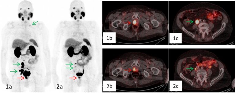 Fig. 8: On the PET-scan prior to therapy local tumour in the prostate bed (red arrow), multiple abdominopelvic and one cervical LN metastases (green arrows) were clearly visible on maximum intensity projection (MIP) (1a) and on fused axial PET/CT-images (1b, 1c). Restaging PET/CT performed eight weeks after administration of 4 cycles of 177Lu-PSMA- 617 with a total accumulated activity of 24.93 GBq showed a markedly reduction of the primary tumour (red arrow) and an impressive partial response of LN-metastases with only small metastases left in the right iliac region (green arrows), as displayed on MIP (2a) and fused axial PET/CT-images (2b, 2c). Image reproduces from [19].