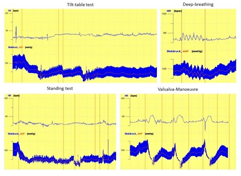 Fig. 1: Alessandra Fanciulli Cardiovascular autonomic function tests in a person with prodromal multiple system atrophy, showing neurogenic orthostatic hypotension and missing blood pressure counter-regulation during the Valsalva manoeuvre, consistent with severe sympathetic adrenergic dysfunction (Alessandra Fanciulli, own material).