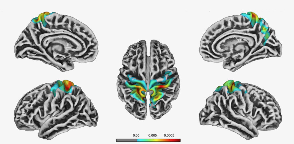 Fig. 2: Christoph Scherfler Caption: Occupation-related effects on motor cortex thickness among older, cognitive healthy individuals: Areas of significant cortical thickness differences in the higher vs. the lower physically complex occupations group. Cranial and lateral view. (Lenhart L., et al., Brain Struct Funct. 2021 May;226(4):1023-1030. doi: 10.1007/s00429-021-02223-w.)