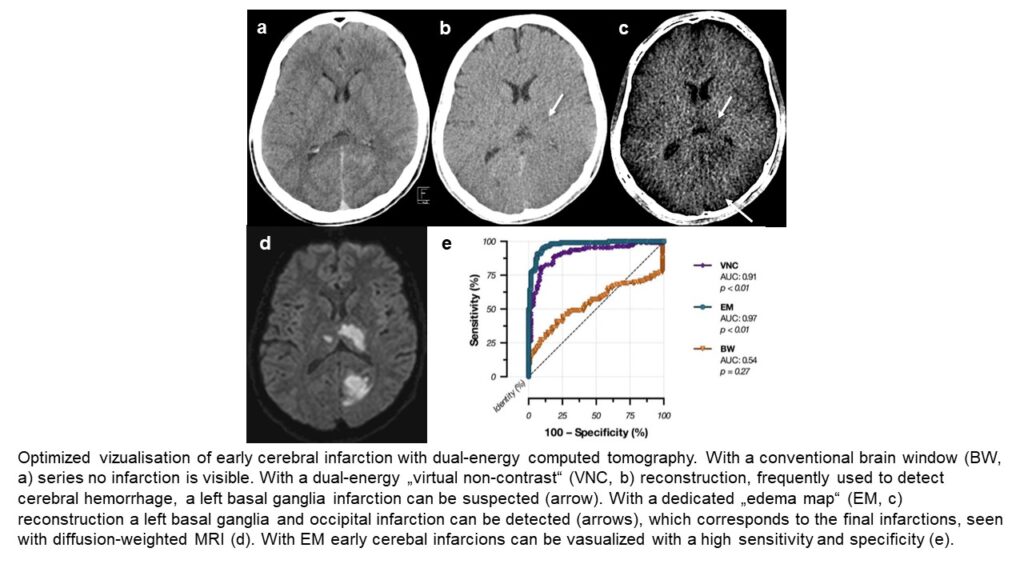 Fig. 2: Optimised visualisation of early cerebral infarction with dual-energy computed tomography. With a conventional brain window (BM, a) series, no infarction is visible. With a dual-energy “virtual non-contrast” (VNC, b) reconstruction, frequently used to detect cerebral haemorrhage, a left basal ganglia infarction can be assumed (arrow). With a dedicated “oedema map” (EM, c) reconstruction, a left basal ganglia and occipital infarction can be detected (arrows), which corresponds to the final infarctions, seen with diffusion-weighted MRI (d). With EM, early cerebral infarctions can be visualised with a high level of sensitivity and specificity (e).