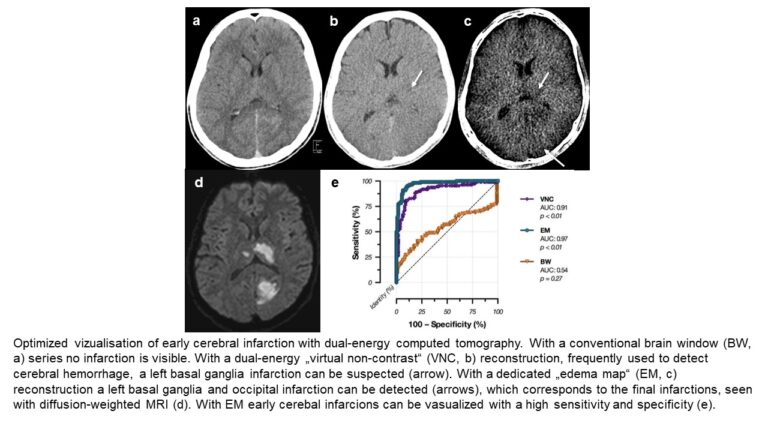 Fig. 2: Optimised visualisation of early cerebral infarction with dual-energy computed tomography. With a conventional brain window (BM, a) series, no infarction is visible. With a dual-energy “virtual non-contrast” (VNC, b) reconstruction, frequently used to detect cerebral haemorrhage, a left basal ganglia infarction can be assumed (arrow). With a dedicated “oedema map” (EM, c) reconstruction, a left basal ganglia and occipital infarction can be detected (arrows), which corresponds to the final infarctions, seen with diffusion-weighted MRI (d). With EM, early cerebral infarctions can be visualised with a high level of sensitivity and specificity (e).