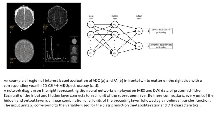 Fig. 3: An example of region-of-interest-based evaluation of ADC (a) and FA (b) in frontal white matter on the right side with a corresponding voxel in 2D CSI 1H-MR spectroscopy (c, d). A network diagram on the right, representing the neural networks employed in the MRS and DWI data of preterm children. Each unit of the input and hidden layer connects to each unit of the subsequent layer. Through these connections, every unit of the hidden and output layer is a linear combination of all units of the preceding layer followed by a non-linear transfer function. The input units x correspond to the variables used for class prediction (metabolite ratios and DTI characteristics).