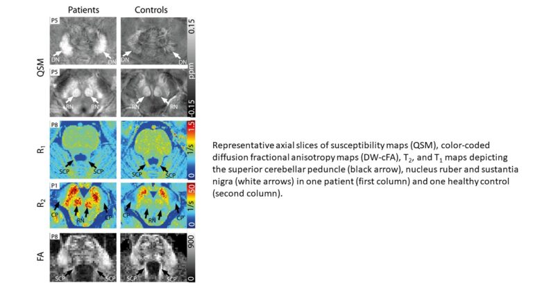Fig. 4: Representative axial slices of susceptibility maps (QSM), colour-coded diffusion of fractional anisotropy maps (DW-cFA), T2 and T1 maps depicting the superior cerebellar peduncle (black arrow), nucleus ruber and sustantia nigra (white arrows) in one patient (first column) and one healthy control (second column).