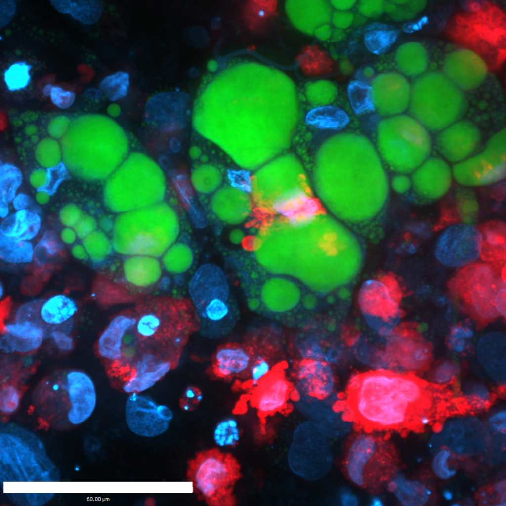Fig. 3: Macrophages engulf adipocytes. Confocal microscopy of lipid-stained (green) in vitro differentiated adipocytes co-cultured for 24h with inflammatory macrophages constitutively expressing mCherry (red). Hoechst 33342 stained nuclei (blue). Scale bar indicate 60 µm (blue); Copyright: Priv. Doz. Dr.rer.nat. C. Ploner; MUI
